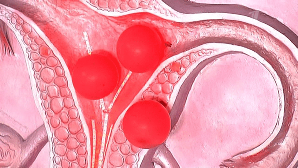 Маточное кровотечение во время. Эндометриальный полип. Плацентарный полип эндометрия. Цервикальный эндометриоз.